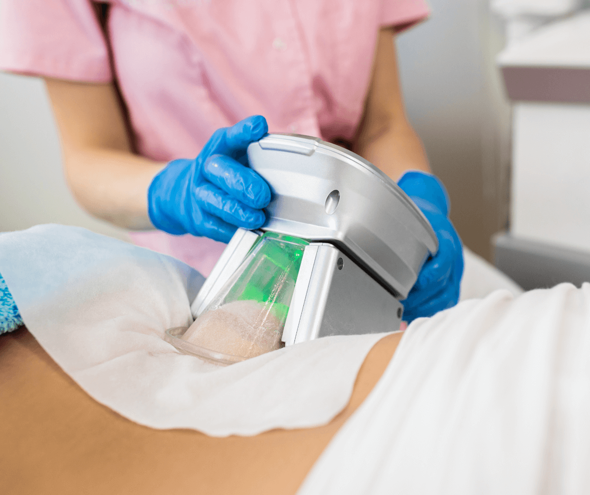 Freeze Away Fat with Cryocell