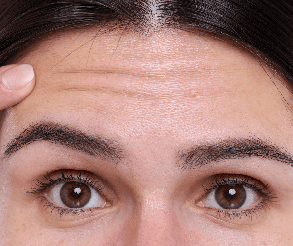 Forehead Lines Image