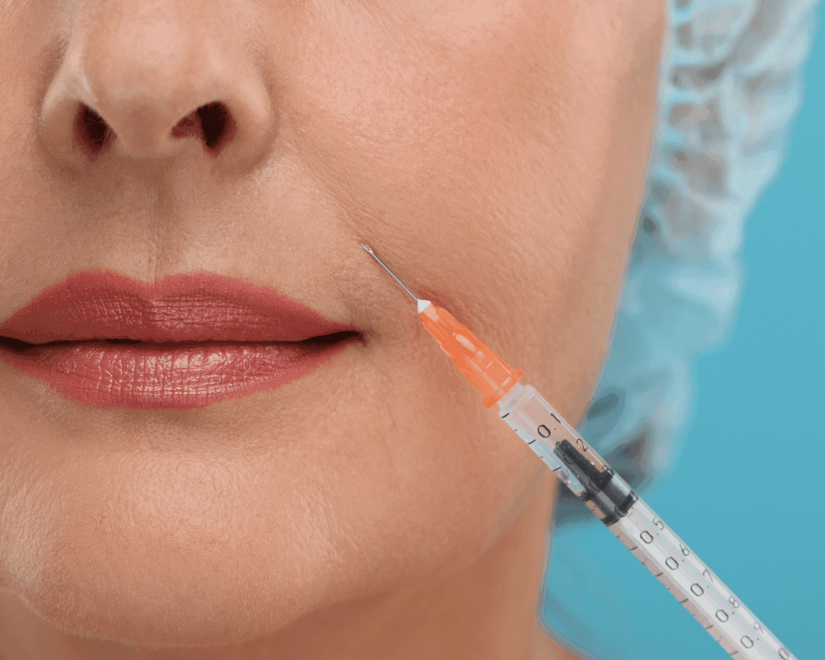 Smile Lines Correction