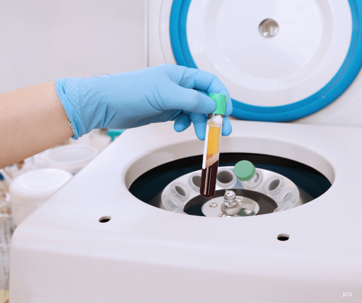 What is a Vampire Facial?