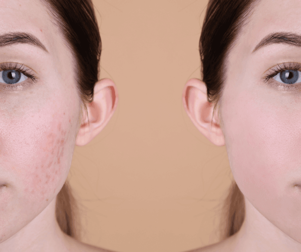 Acne & Scar Management